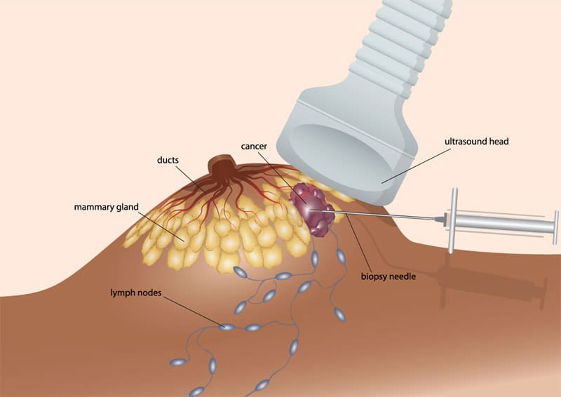 Illustration of an ultrasound-guided breast biopsy, showing the ultrasound probe and biopsy needle near a tumor.